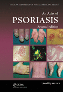 An Atlas of Psoriasis, Second Edition