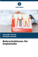 Bohrschablonen f?r Implantate