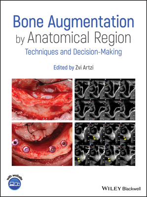 Bone Augmentation by Anatomical Region: Techniques and Decision-Making - Artzi, Zvi (Editor)
