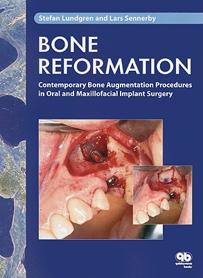 Bone Reformation: Contemporary Bone Augmentation Procedures in Oral and Maxillofacial Implant Surgery - Lundgren, Stefan, and Sennerby, Lars