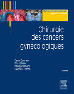 Chirurgie Des Cancers Gynecologiques