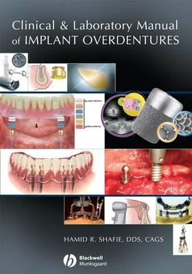 Clinical and Laboratory Manual of Implant Overdentures - Shafie, Hamid R