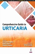 Comprehensive Guide to Urticaria