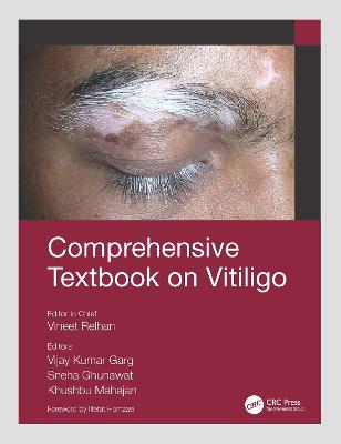 Comprehensive Textbook on Vitiligo - Relhan, Vineet (Editor), and Garg, Vijay Kumar (Editor), and Ghunawat, Sneha (Editor)