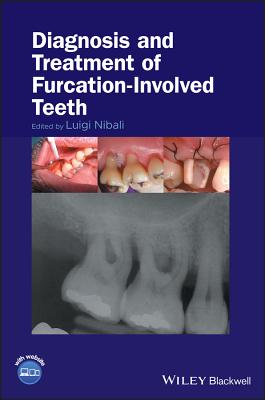 Diagnosis and Treatment of Furcation-Involved Teeth - Nibali, Luigi (Editor)