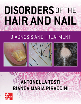 Disorders of the Hair and Nail: Diagnosis and Treatment - Tosti, Antonella, and Piraccini, Bianca Maria