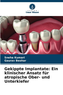 Gekippte Implantate: Ein klinischer Ansatz f?r atropische Ober- und Unterkiefer - Kumari, Sneha, and Beohar, Gaurav