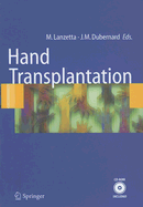 Hand Transplantation