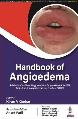 Handbook of Angioedema - Godse, Kiran V, and Patil, Anant