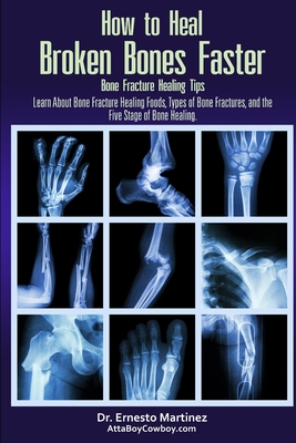 How to Heal Broken Bones Faster. Bone Fracture Healing Tips: Learn About Bone Fracture Healing Foods, Types of Bone Fractures, and the Five Stages of Bone Healing - Martinez, Ernesto, Dr.