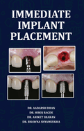 Immediate Implant Placement