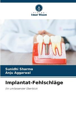 Implantat-Fehlschlge - Sharma, Sunidhi, and Aggarwal, Anju