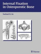 Internal Fixation in Osteoporotic Bone - An, Yuehuei H. (Editor)