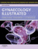 Gynaecology Illustrated 6/E