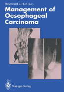 Management of Oesophageal Carcinoma