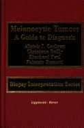 Melanocyctic Tumours: A Guide to Diagnosis