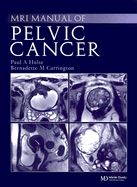 MRI Manual of Pelvic Cancer