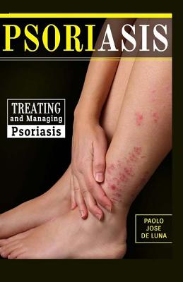 Psoriasis: Treating and Managing Psoriasis - Jose De Luna, Paolo