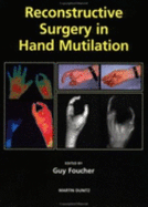 Reconstructive Surgery in Hand Mutilation