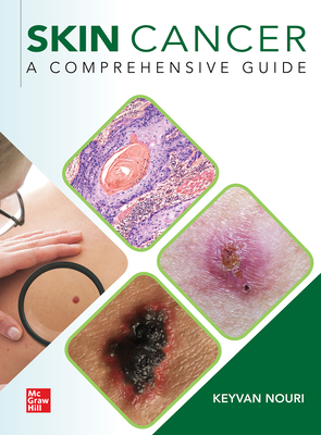 Skin Cancer: A Comprehensive Guide - Nouri, Keyvan