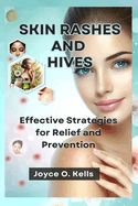 Skin Rashes and Hives: Effective Strategies for Relief and Prevention