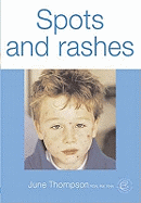 Spots and Rashes
