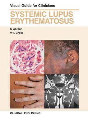 Systemic Lupus Erythematosus: Visual Guide for Clinicians - Gordon, C., and Gross, W. L.