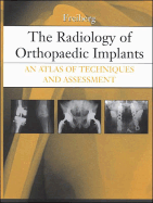 The Radiology of Orthopaedic Implants: An Atlas of Techniques and Assessment