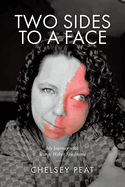 Two Sides to a Face: My Journey with Sturge Weber Syndrome