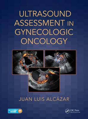 Ultrasound Assessment in Gynecologic Oncology - Alczar, Juan Luis