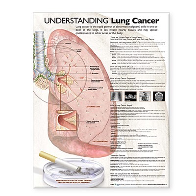 Understanding Lung Cancer Anatomical Chart - Anatomical Chart Company (Prepared for publication by)