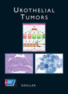 Urothelial Tumors
