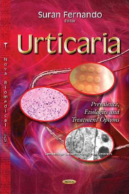 Urticaria: Prevalence, Etiologies & Treatment Options - Fernando, Suran (Editor)