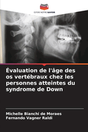 ?valuation de l'?ge des os vert?braux chez les personnes atteintes du syndrome de Down